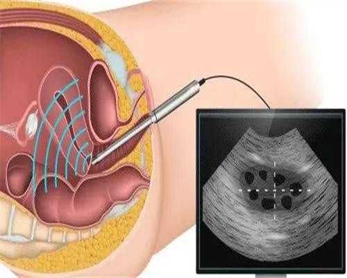 泰国第三代试管：国内三代试管医院哪家好？广州医院的技术差别怎么看？